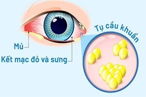 Đơn thuốc bệnh đau mắt đỏ