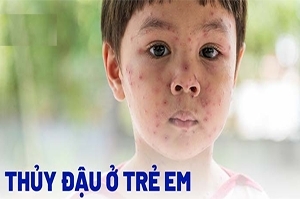 Đơn BỆNH THỦY ĐẬU Ở TRẺ EM