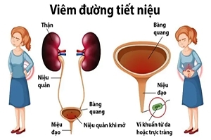 Đơn viêm đường tiết niệu, bàng quang