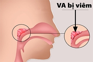 Đơn thuôc viêm thanh quản, họng hat, VA, viêm phổi cấp