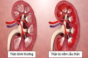 Đơn bệnh viêm cầu thận cấp