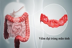 Đơn bệnh viêm đại tràng mãn tính