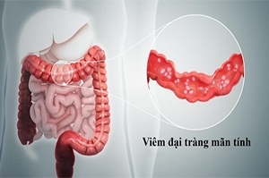 Đơn thuốc viêm đại tràng mãn tính