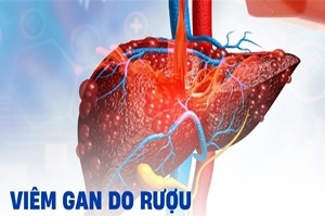 Đơn bệnh viêm gan do bia rượu 