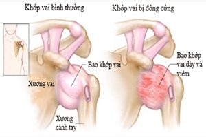 Đơn thuốc viêm khớp cho mọi đối tượng