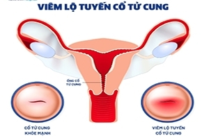 Đơn VIÊM CỔ TỬ CUNG, VIÊM LỘ TUYẾN, VIÊM NHIỄM PHẦN PHỤ